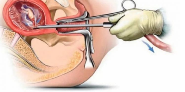 सूचीकृत स्वास्थ्य संस्थामा सुरक्षित गर्भपतन