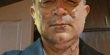 पोखराका मेयर धनराज आचार्य डिस्चार्ज